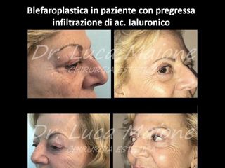 Blefaroplastica - Dott. Luca Maione