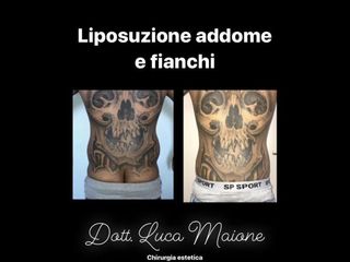 Liposuzione - Dott. Luca Maione