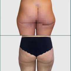 Liposcultura trocantere o "culotte de cheval"