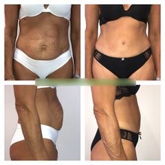 Liposuzione - Dr Antonio Tambuscio