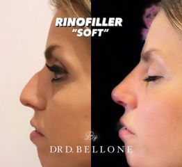 Rinofiller - Dott. Bellone Donato