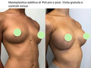 Mastoplastica additiva - Dott. Alberto Poli Cliniche Nova Genesis