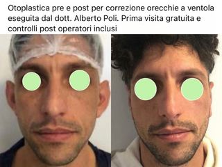 Otoplastica - Dott. Alberto Poli Cliniche Nova Genesis