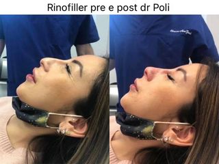 Rinofiller - Dott. Alberto Poli Cliniche Nova Genesis