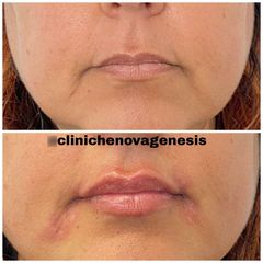 Filler labbra - Dott. Alberto Poli Cliniche Nova Genesis