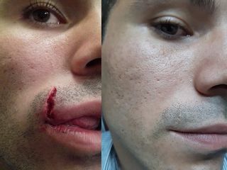 Pre e Post revisione chirurgica labbro