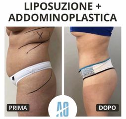 Liposuzione - Dott. Orlandi Alberto