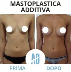 Mastoplastica additiva - Dott. Orlandi Alberto