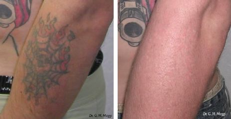 Asportazione tatuaggio prima e dopo