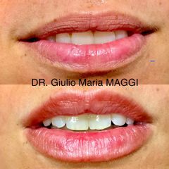 Filler labbra - Aesthetic Clinic del Dott. Giulio Maria Maggi