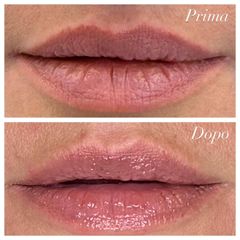 Dott. Giulio Maria Maggi Filler Labbra