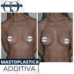 Mastoplastica dditiva - Dottor Gianluca Campiglio