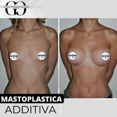 Mastoplastica additiva - Dottor Gianluca Campiglio