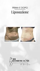 Liposuzione - Dr Benoit Menye