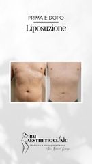 Liposuzione - Dr Benoit Menye