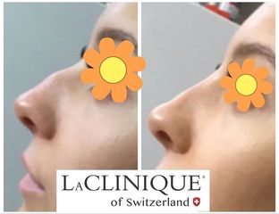 Rinofiller - LaCLINIQUE of Switzerland®