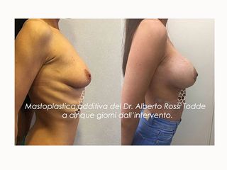 Mastoplastica additiva prima e dopo