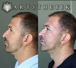 Hilos tensores - Artsthetik Dr. Gabo