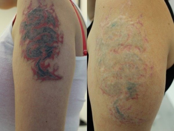 Usuwanie tatuażu laserem