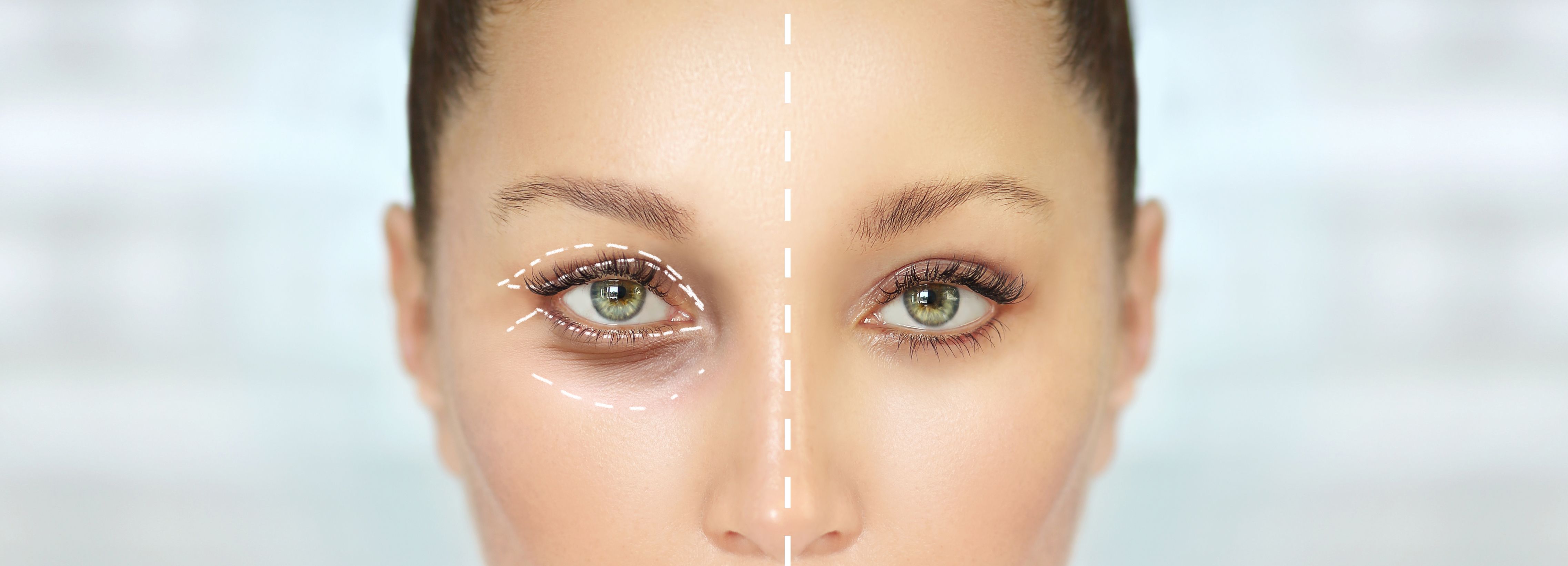 Blefaroplastyka efekty, rekonwalescencja