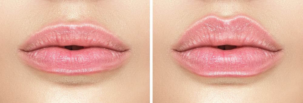 Lip lift