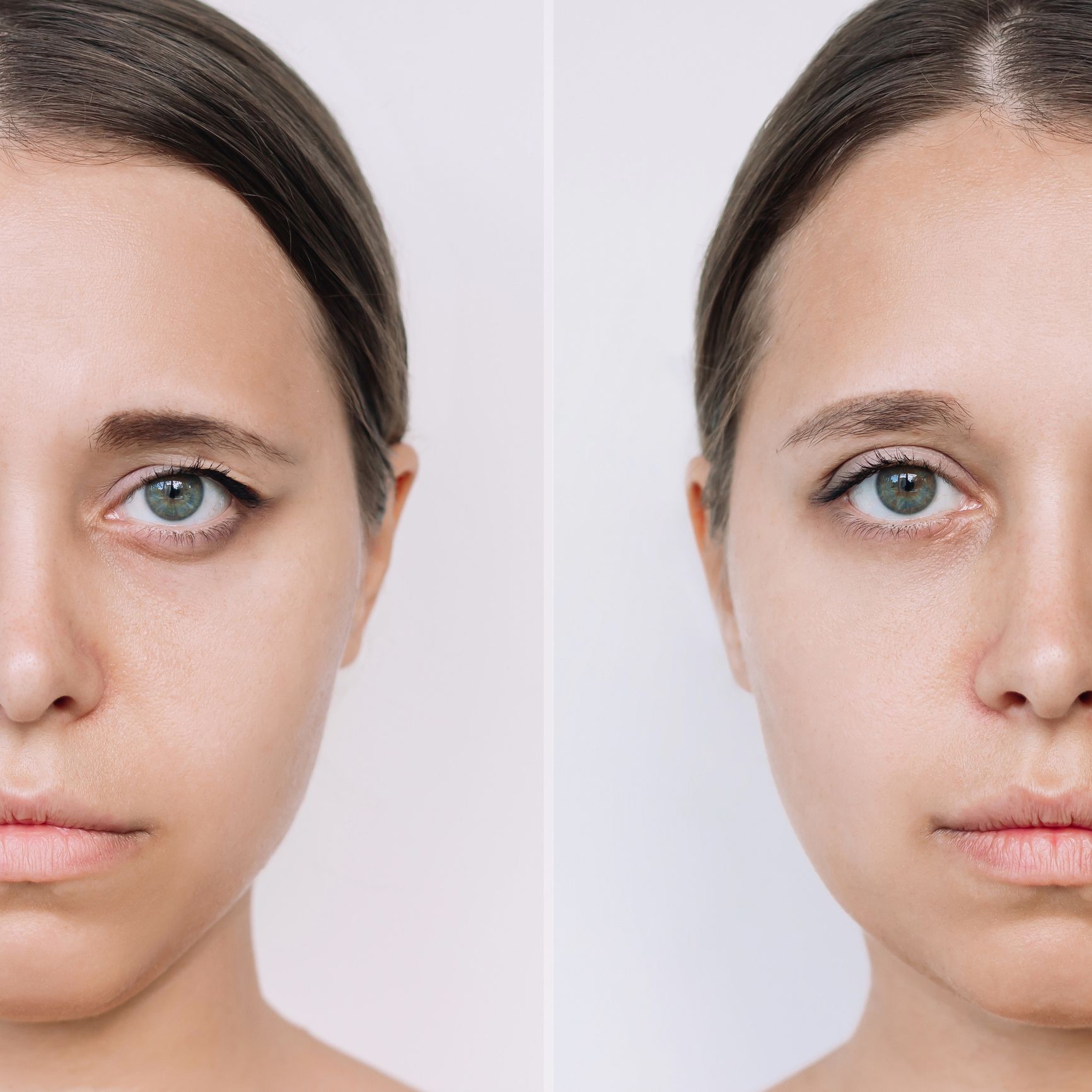 Blefaroplastyka chirurgiczna, niechirurgiczna czy laserowa?
