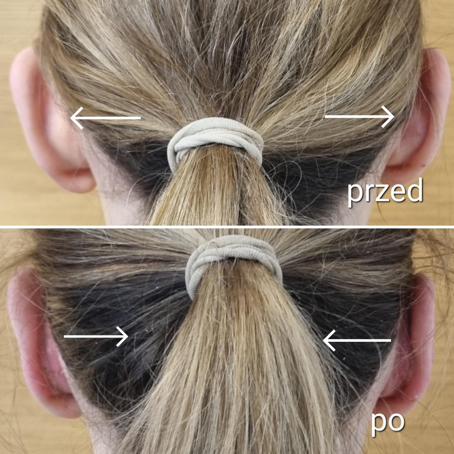 Przed i po zabiegu korekty uszu
