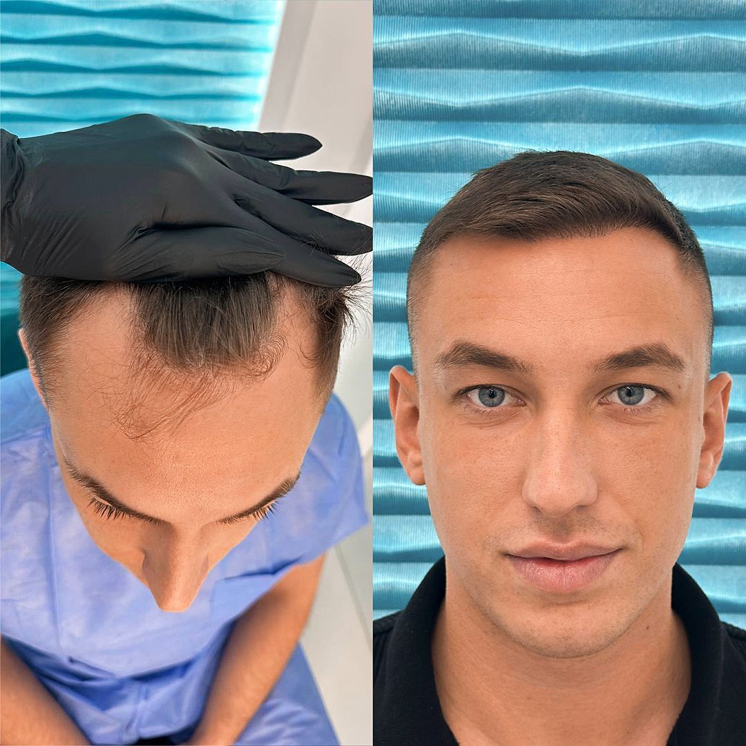 Przeszczep wlosow przed i po