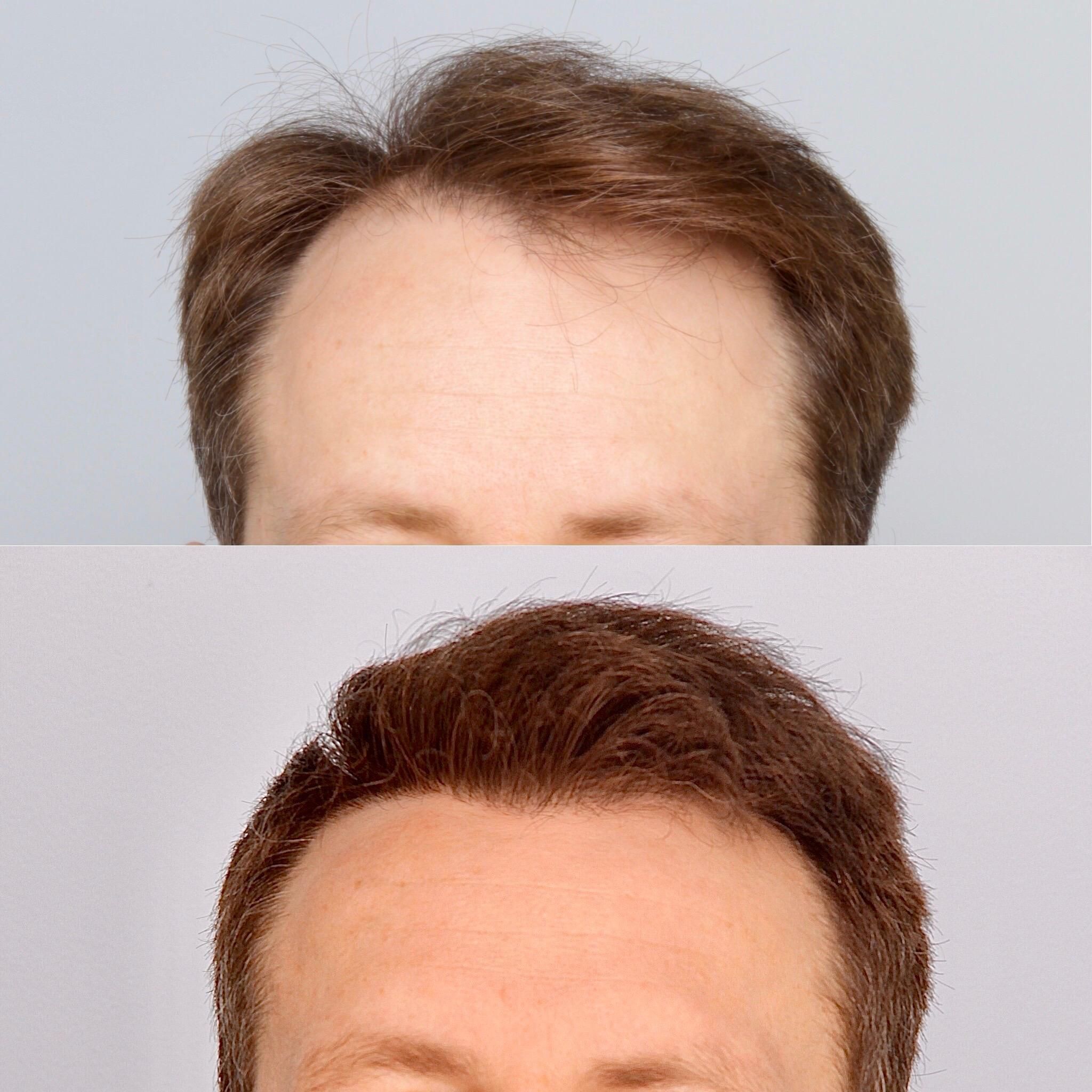 Przeszczep włosów: przed i po