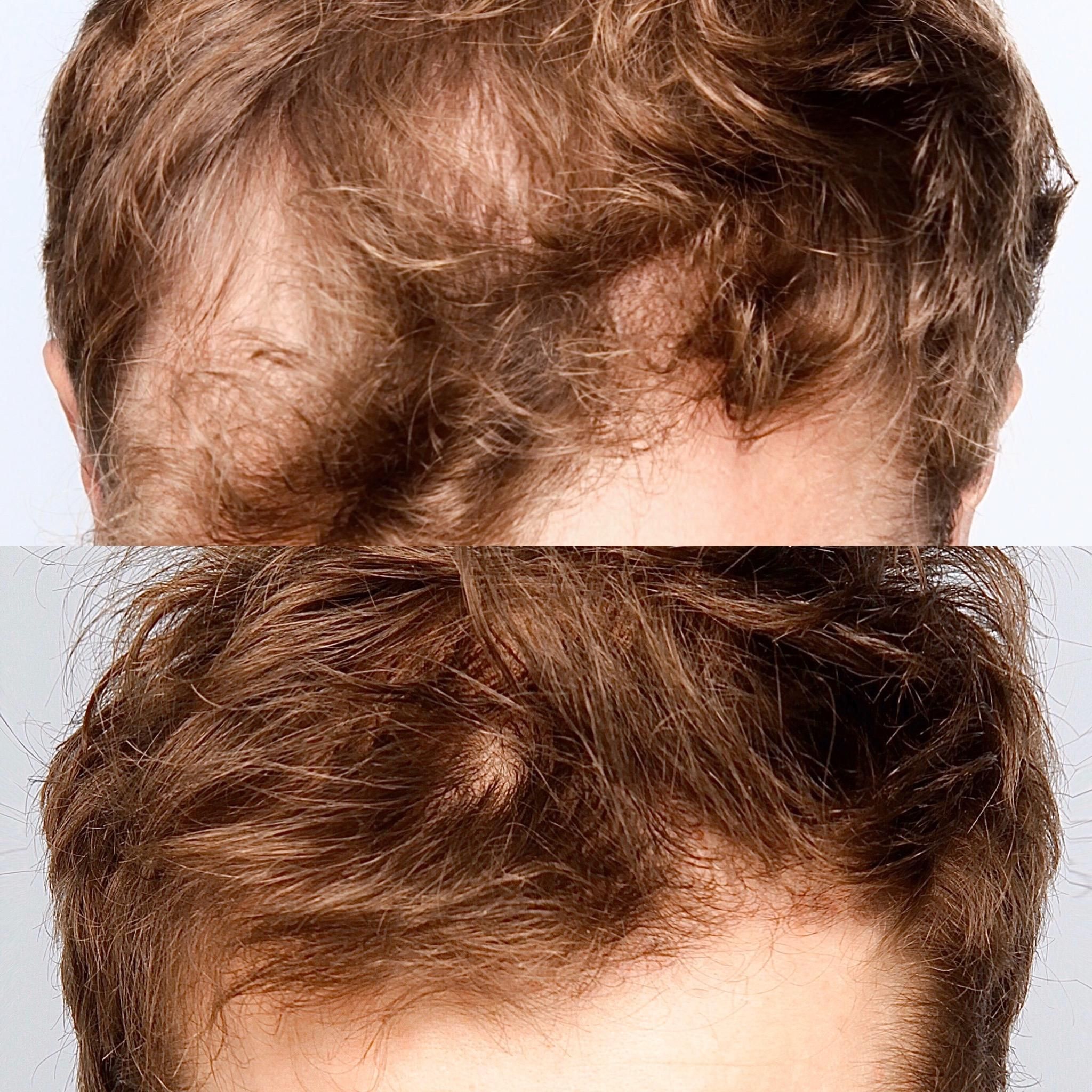 Przeszczep włosów: przed i po