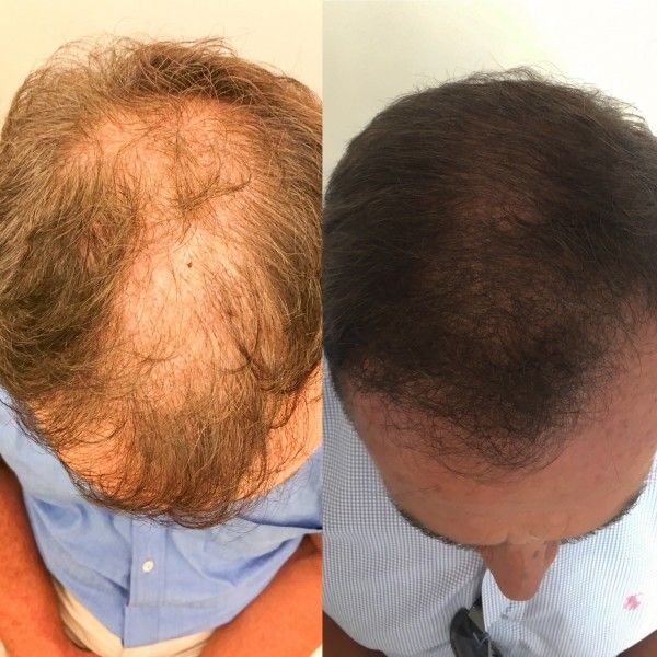 Przed i po przeszczepie włosów