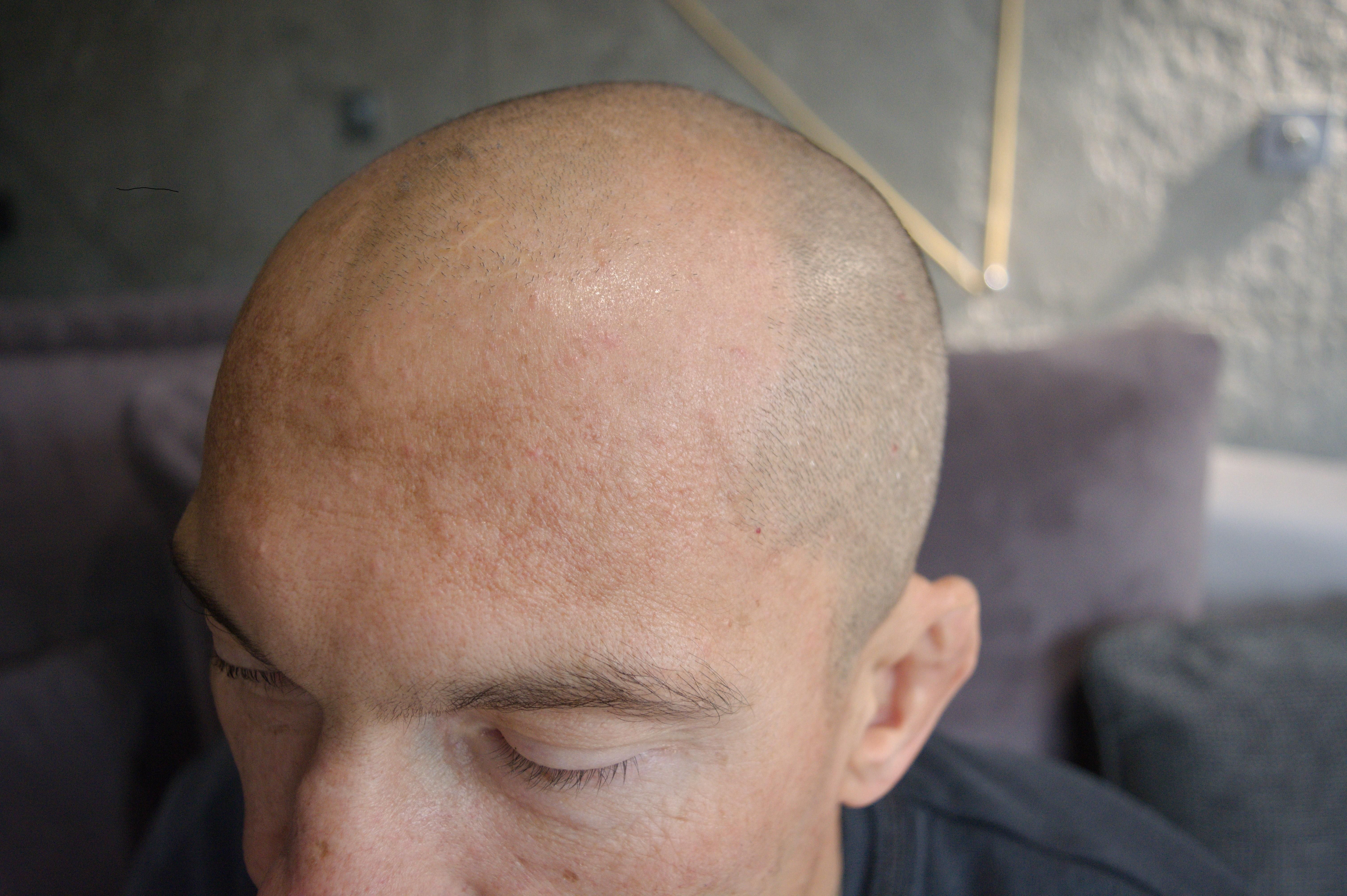 Mikropigmentacja skóry głowy - przed