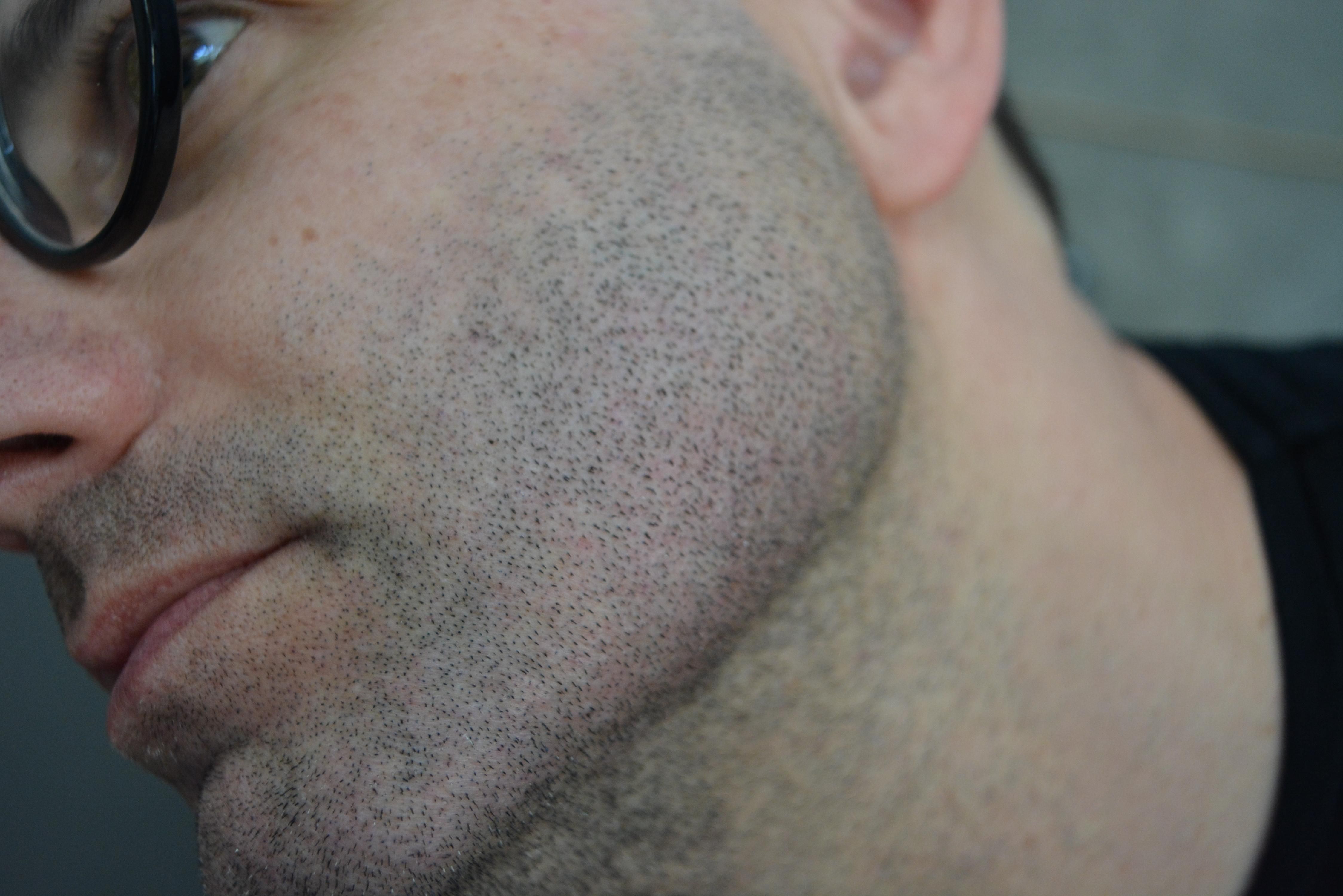 Mikropigmentacja brody