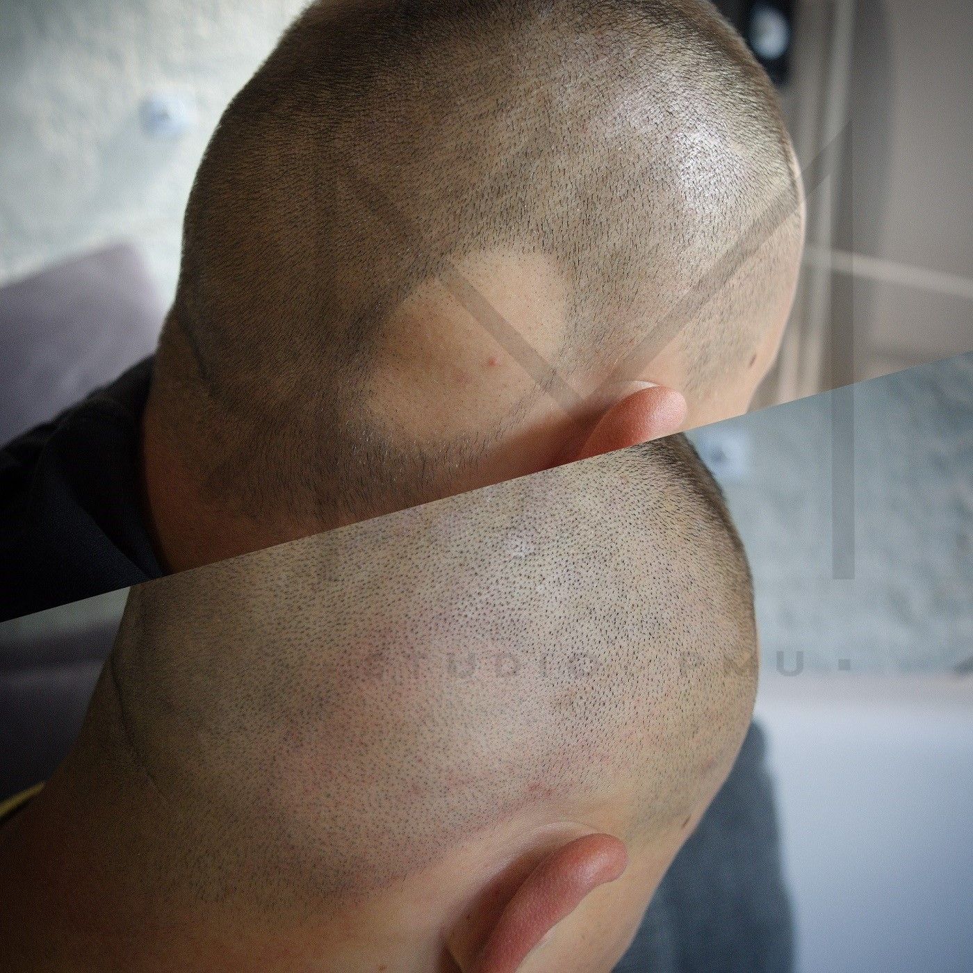 Mikropigmentacja skóry głowy - przed i po