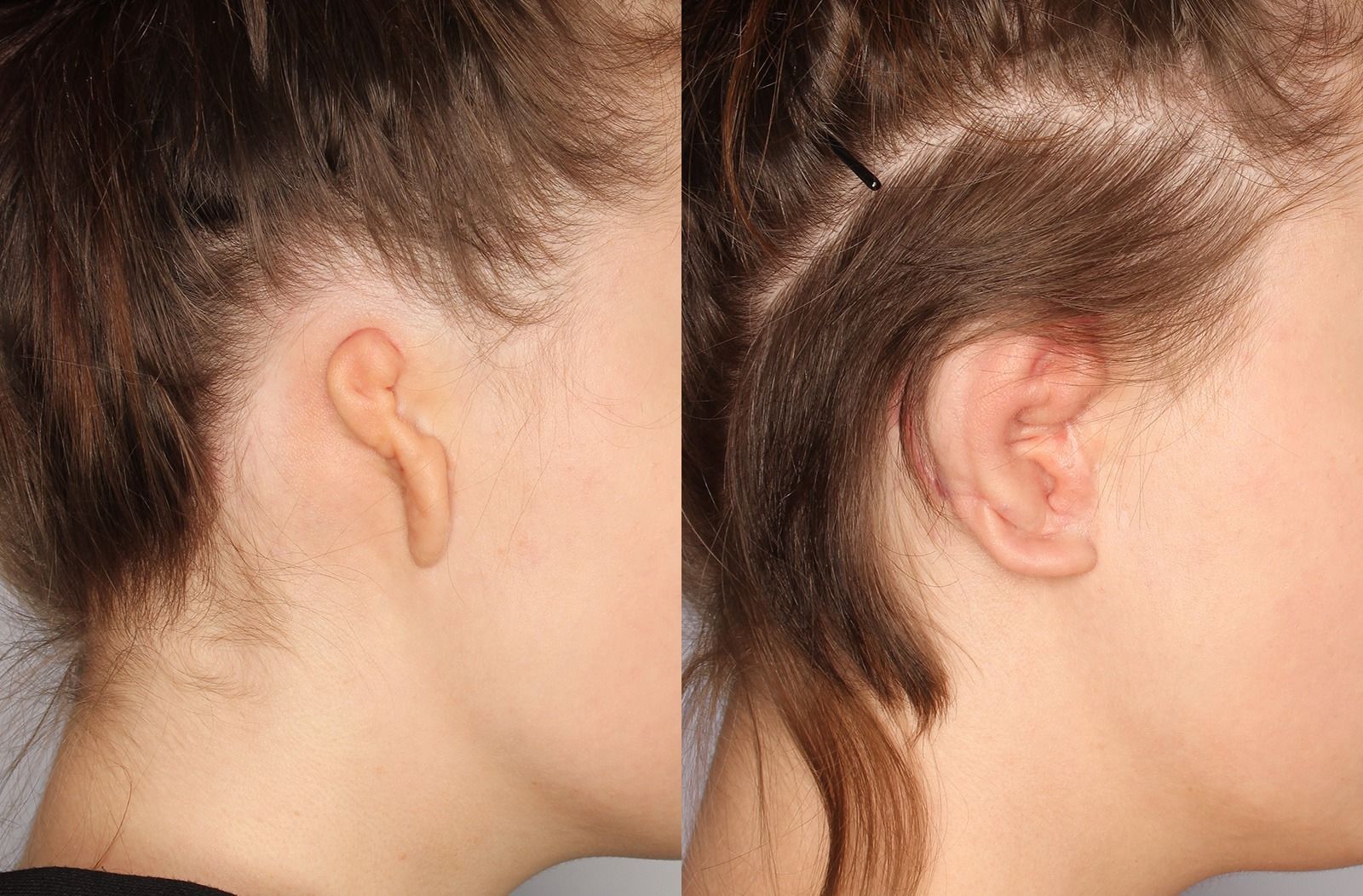 Efekty rekonstrukcji ucha