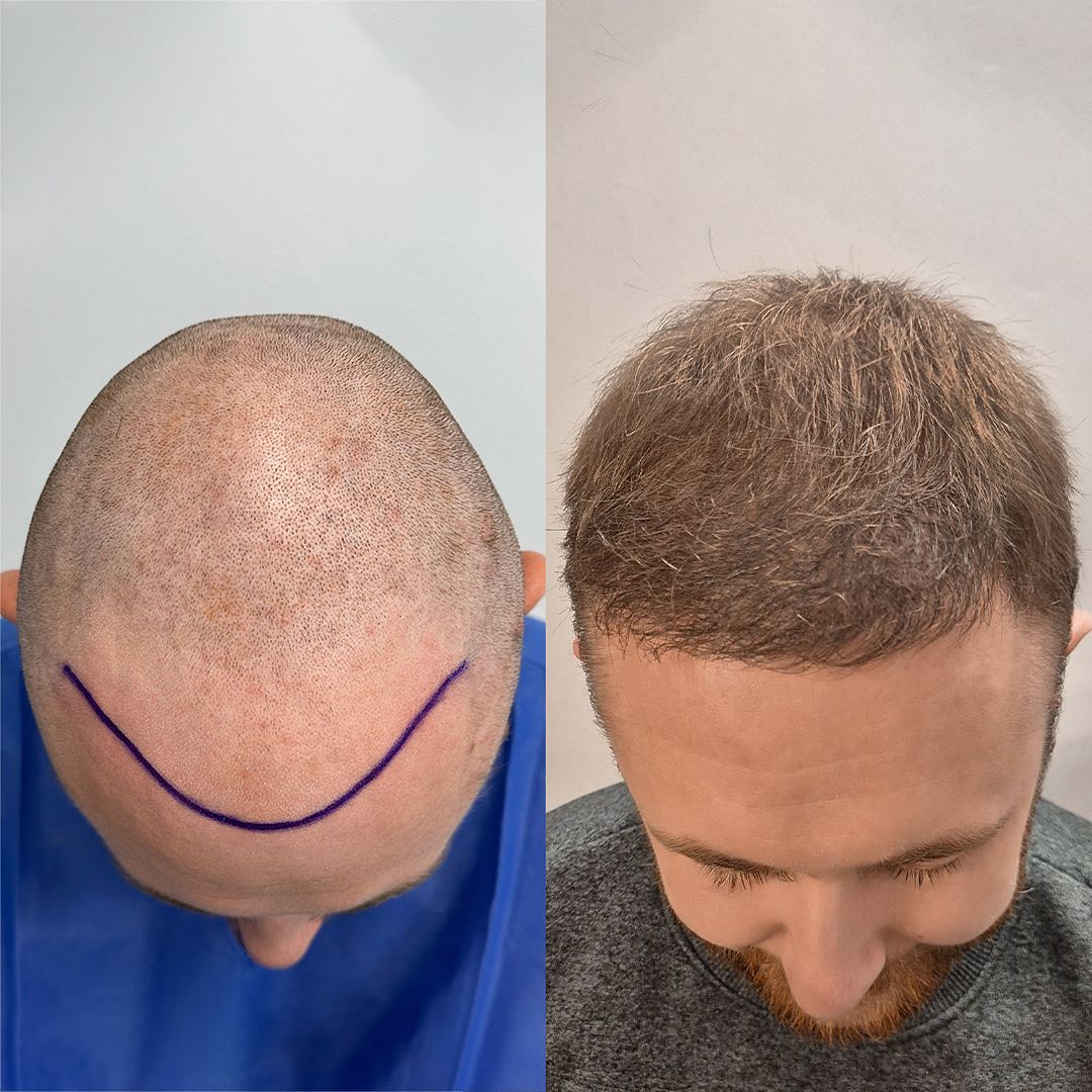 Przeszczep wlosow przed i po