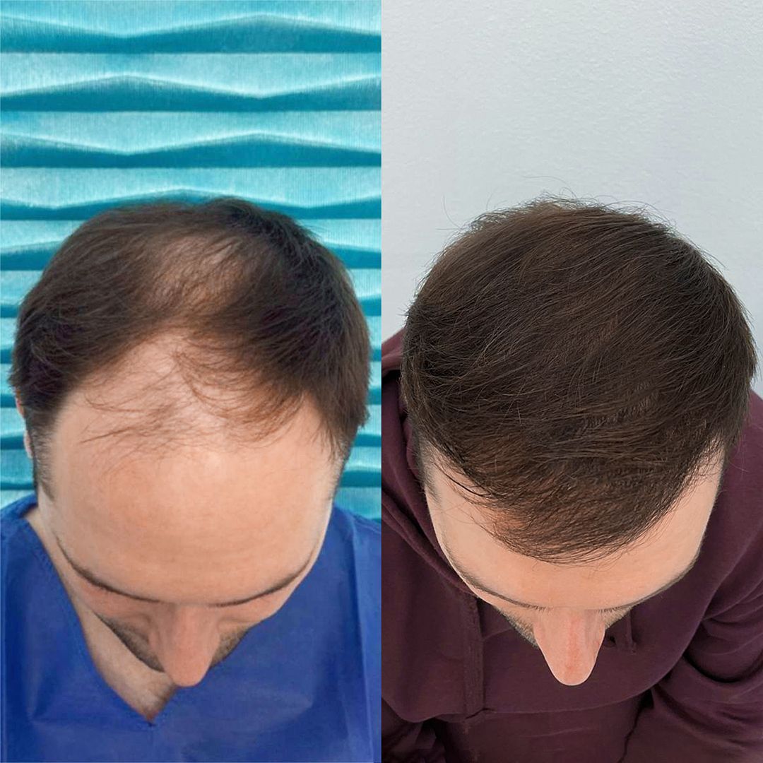 Przeszczep wlosow przed i po