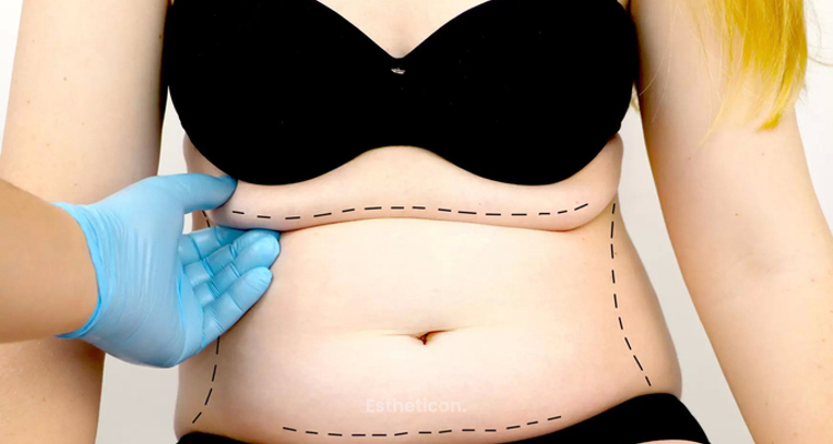 Co warto wiedzieć na temat liposukcji infradźwiękowej?