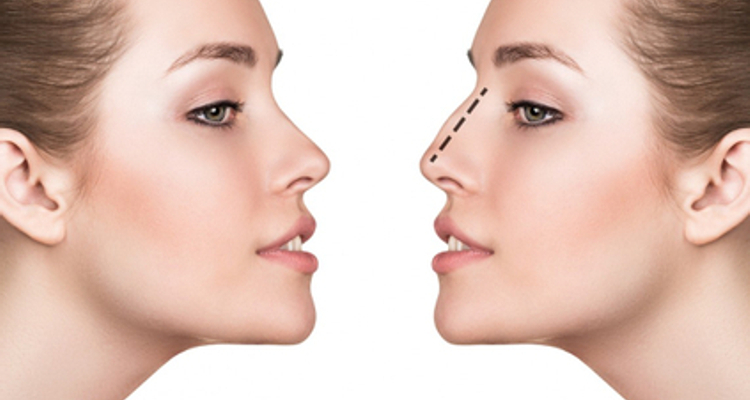 Efekty korekcji nosa - nos idealny