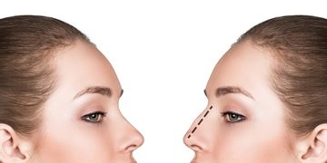 Efekty korekcji nosa - nos idealny