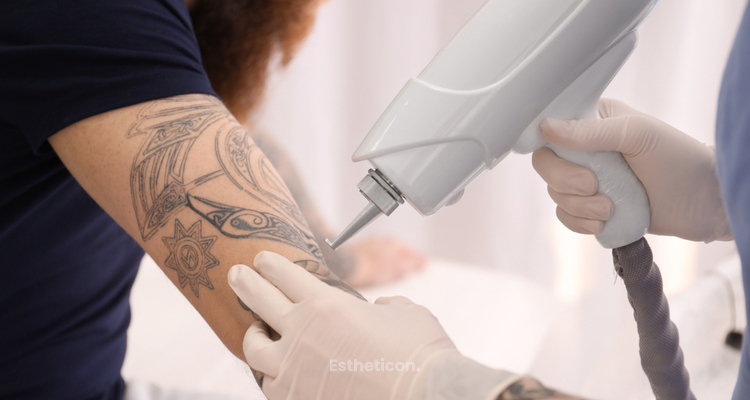 Jak usunąć niechciany tatuaż?