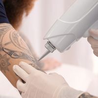 Jak usunąć niechciany tatuaż?
