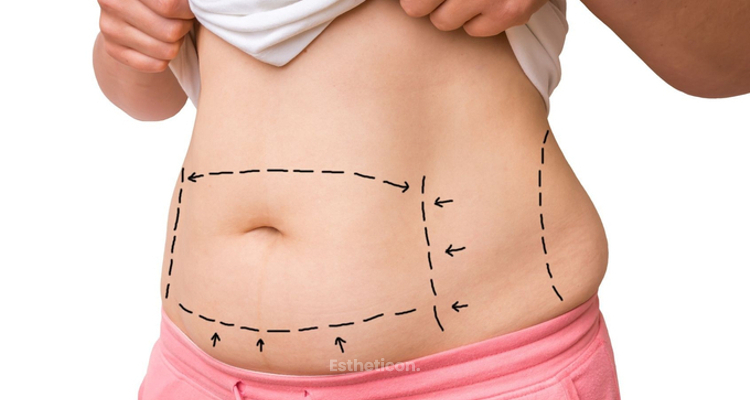 Liposukcja wodna – nowatorski sposób redukcji tkanki tłuszczowej