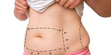 Liposukcja wodna – nowatorski sposób redukcji tkanki tłuszczowej Liposukcja wodna – nowatorski sposób redukcji tkanki tłuszczowej
