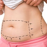 Liposukcja wodna – nowatorski sposób redukcji tkanki tłuszczowej