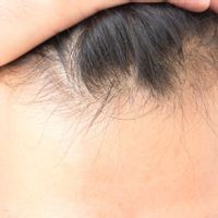 Wskazania do transplantacji włosów i zalety metody FUE