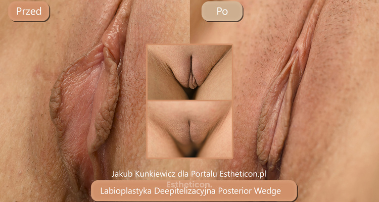 Labioplastyka jak świadomie wybrać metodę i specjalistę?