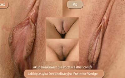 Labioplastyka jak świadomie wybrać metodę i specjalistę?
