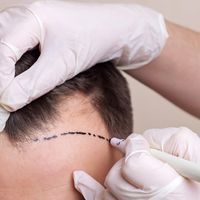 Przeszczep włosów – jaką metodę wybrać?