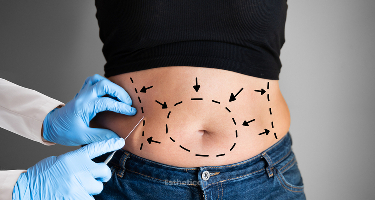 Jak dbać o bliznę po abdominoplastyce?